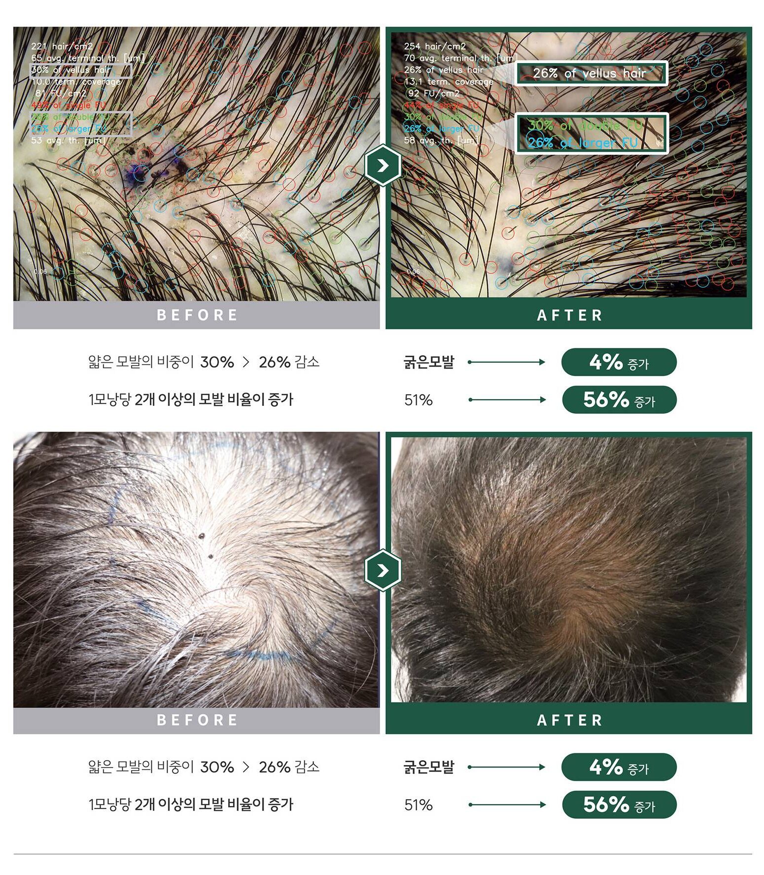 자가모근줄기세포 사진